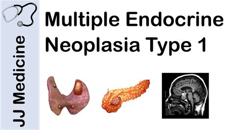 Multiple Endocrine Neoplasia Type 1 (MEN-1) | Signs and Symptoms ...