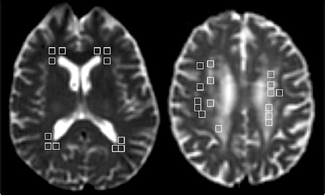 leukoaraiosis - meddic