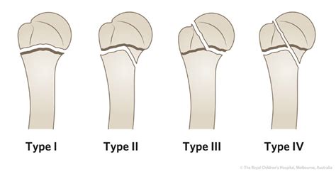 Clinical Practice Guidelines : Proximal humeral fractures - Emergency ...