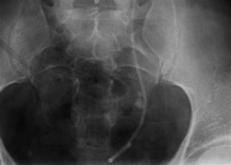 Kidney Stone X-Rays | Flickr - Photo Sharing!