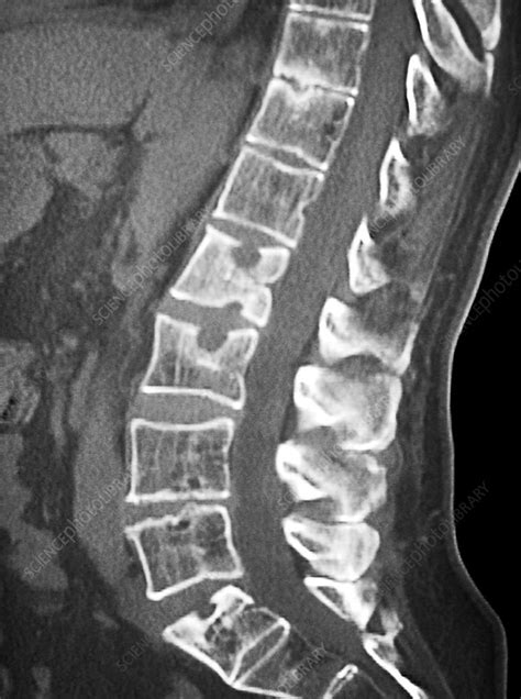 Ankylosing spondylitis, spine CT scan - Stock Image - C021/5440 - Science Photo Library