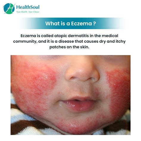 Eczema: Symptoms, Diagnosis and Treatment – Healthsoul