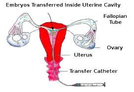 Embryo Transfer Procedure For in Vitro Fertilization