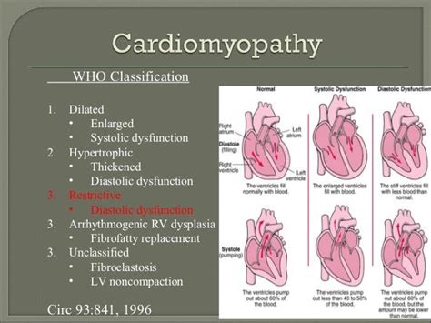 Restrictive cardiomyopathy