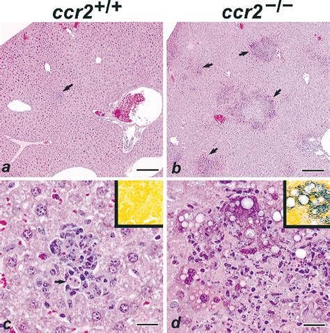 Acute monocytic leukemia | Semantic Scholar