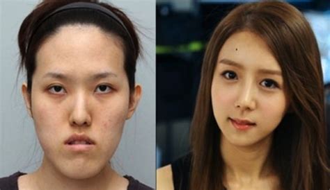 Crazy Before And After Photos Of South Korean Plastic Surgery