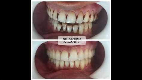 Remove gutka stains. #dentist #braces #dentalcare #teeth # ...