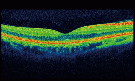 Optical Coherence Tomography | Varcoe Eyecare | Optometrists ...