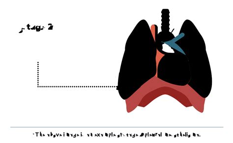 4 Stages of Mesothelioma | Symptoms & Treatment by Stage