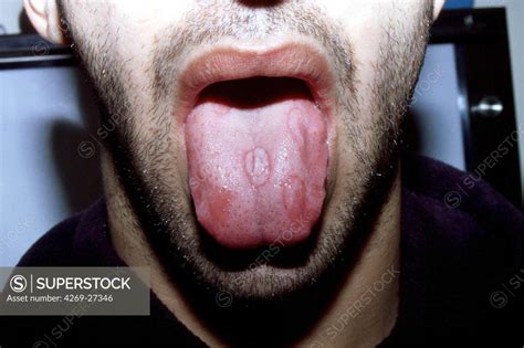 Syphilis. Secondary syphilitic chancre (ulcer) on the tongue of man with secondary syphilis ...