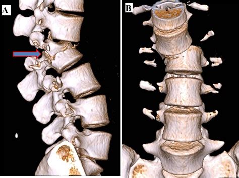 Seat belt syndrome with unstable Chance fracture dislocation of the ...