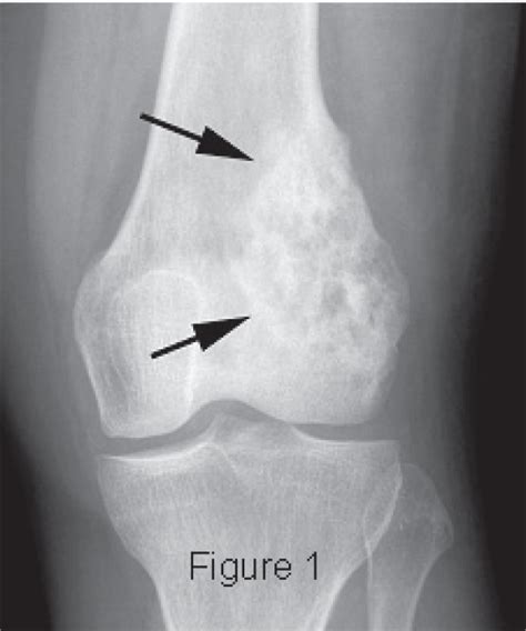 Osteosarcoma X Ray