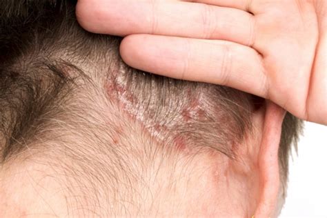 Mild Psoriasis | www.pixshark.com - Images Galleries With A Bite!