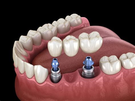 Implant Retained Bridge | Restorative Dental | Hutt Dental Implant Clinic