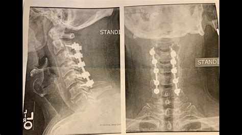 2 MONTH POST SURGERY: POSTERIOR CERVICAL DECOMPRESSION AND FUSION C2-C6 - NECK SURGERY - YouTube