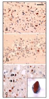 Pick's Disease: Causes, Picture, Symptoms And Treatment