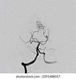 Cerebral Angiogram Medical Imaging Procedure Used Stock Photo 2391488017 | Shutterstock