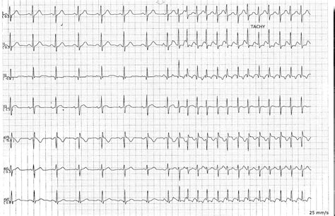 ECG Rhythms: Can you see the P?