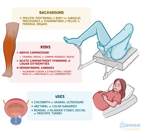 Lithotomy Position: What Is It and Its Uses | Osmosis