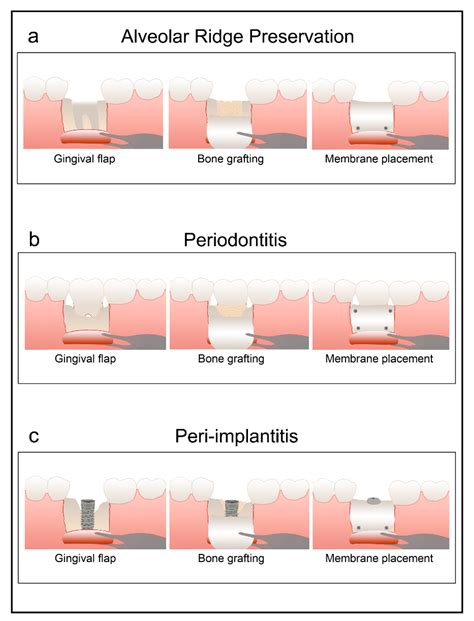 Polymers | Free Full-Text | Zn-Containing Membranes for Guided Bone ...