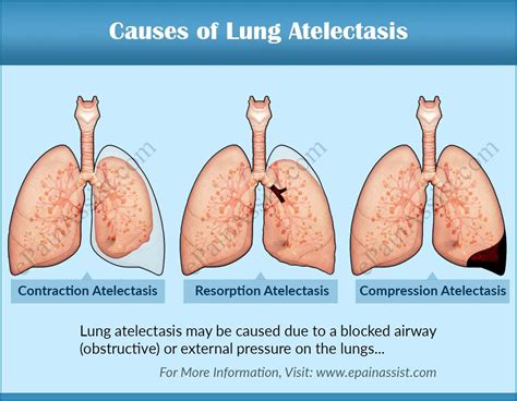 Atelectasis Diagram