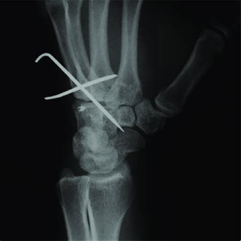 Postoperative plain film X-ray showed reduction of the hamate bone ...