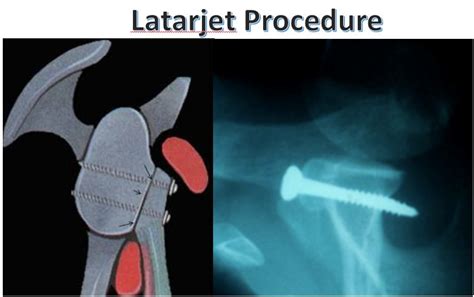 Boston Shoulder Institute – LATARJET PROCEDURE