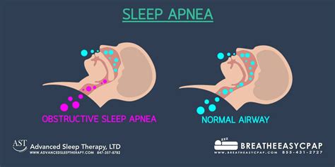 Sleep Apnea Definition – 3 Kinds of Sleep Apnea – CPAPTEAM