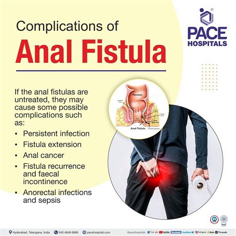 Anal fistula - Symptoms, Causes, Types, Complications, Prevention