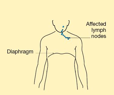 Hodgkin's Lymphoma Cancer Stage 3 Survival Rate