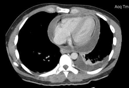 Cardiac tamponade | Radiology Reference Article | Radiopaedia.org