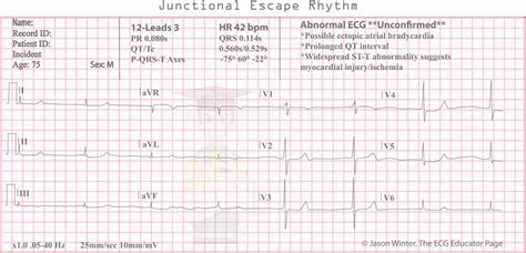 Junctional Escape Beat Ecg