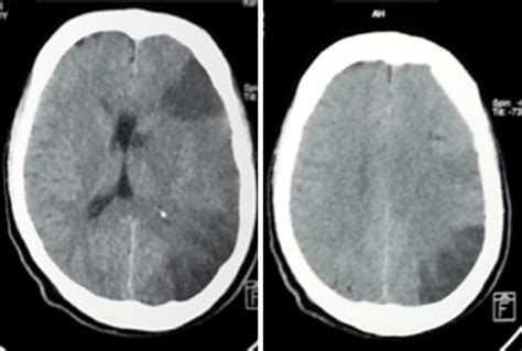 The head computed tomography (CT) showed hypoattenuation in cortical... | Download Scientific ...