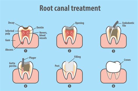 How To Tell If You Need A Root Canal Or A Filling : Do I Need A Root Canals Endodontist ...