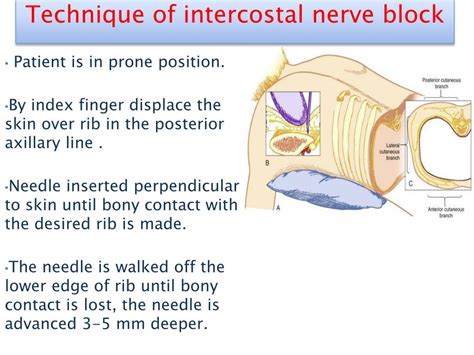 Intercostal Nerve Block Procedure – NBKomputer