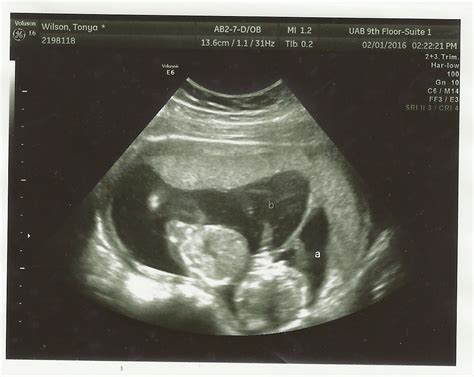 15 weeks ultrasound - Twiniversity