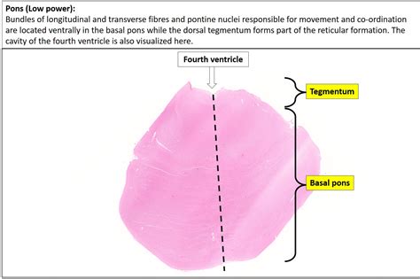 Brain – Pons – NUS Pathweb :: NUS Pathweb