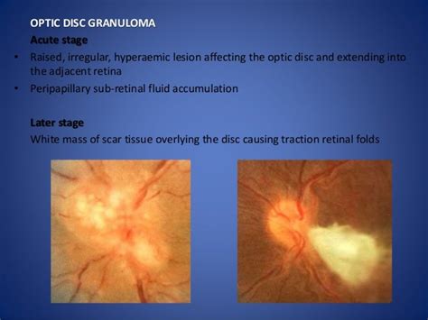 Optic disc evaluation