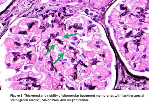 Membranous Nephropathy Histology