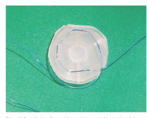 Figure 3 from Insertion of nasal septal button in the treatment of ...