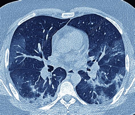 Pneumonia Lung Ct Scan