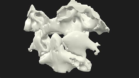 C2 Dens Type 2 fracture - 3D model by 3D Atlas of Neurological Surgery (@tspiriev) [086578e ...