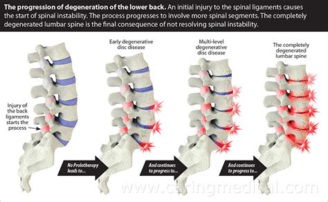 Lumbar Spine Degeneration