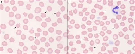 Acanthocytes causes, symptoms, diagnosis, treatment & prognosis