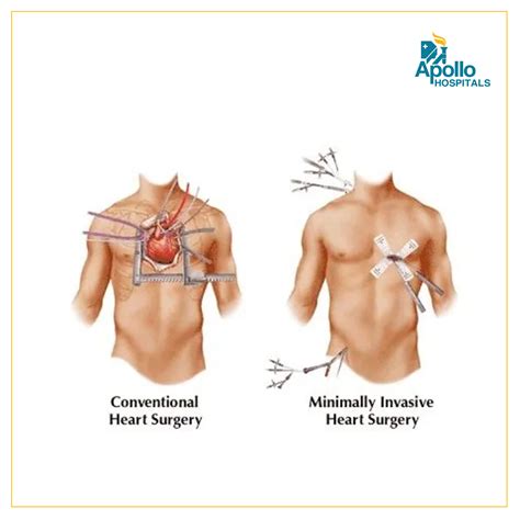 MINIMALLY INVASIVE (CABG) CORONARY ARTERY BYPASS GRAFT, 40% OFF