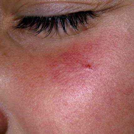 Spider Angiomas – Causes, Symptoms, Treatment