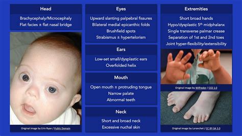 Down Syndrome: Dysmorphic Features - YouTube