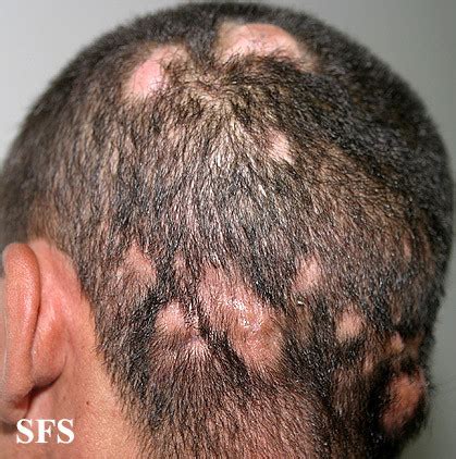 Itchy Scalp – Pictures, Causes and Treatment | Healthhype.com