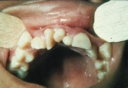 Lesley Paul V.J.'s Blog: Presence of Supernumerary Teeth and its Causes