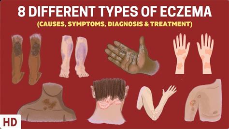 Can eczema look like a fungal infection? – Tipseri